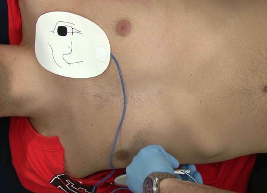 Rescuers should begin chest compressions as soon as possible, and use the AED as soon as it is available and ready.