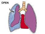 Tension Pneumothorax Two things about a tension pneumothorax: - It is a common cause of preventable death on the battlefield. - It can be effectively treated by combat medics, corpsmen, and PJs.