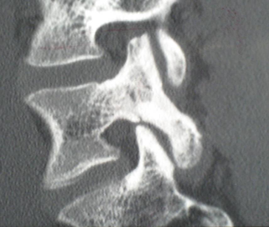 orientated pedicle (Bogduk, 1997). The pars region is therefore placed under stress as bending forces are absorbed where the lamina and pedicle intersect (Bogduk, 1997).