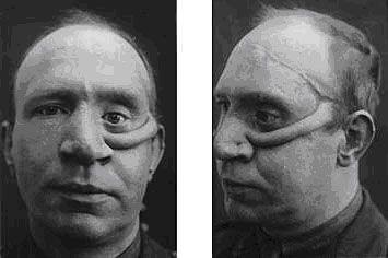 He was interested in trying to discover ways of replacing and restoring parts of the face that had been destroyed. He devised different operations when new injuries appeared.