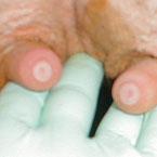 6 Figure 1: Teat-end hyperkeratosis, where the area is hardened due to excessively applied stress [1] Eventually, fluids may even collect outside of channels.