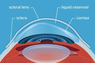 Many cases of early keratoconus or other corneal irregularities can be managed well with corneal gas permeable lenses too, and there are specific designs available to help further in these cases.