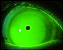 The lens does NOT meet the criteria when any of these problems exist: Contact with central cornea greater than feather touch Central bubble Black arc of touch inside the limbus Impingement of