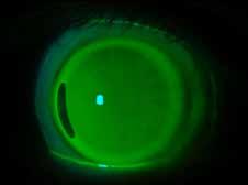If clearance inside the black arc is good, decrease the RZD while increasing the LZA. Decrease the RZD 50 microns for every 1 degree of LZA increase if the central corneal clearance is acceptable.