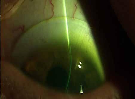 Ideal LZA after conjunctival compression Other Fitting & Problem Solving Concepts: What to do for poor visual acuity; If, Corneal and refractive cylinder are near equal Centered