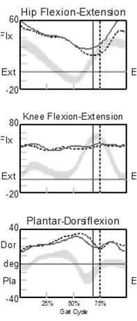 s in CP Increased plantar flexion knee extension couple ankle plantar flexor tightness/spasticity - Increased Knee Flexion/Ankle Dorsiflexion Stance