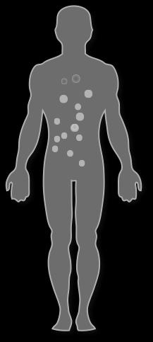 Symptoms of Decompression Sickness TYPE I Less Severe Typically called the bends, producing pain.