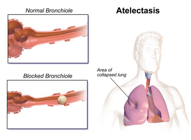 Image: Atelectasis by BruceBlaus. License: CC BY-SA 4.0 The A-a gradient is increased as deoxygenated blood enters the arterial (systemic) circulation decreasing the arterial oxygen tension, P a O 2.