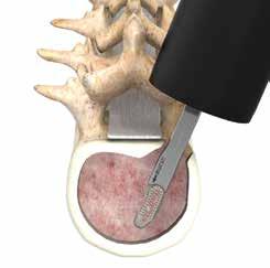 Disc Preparation and Removal Identify the offending disc material, and enter the disc space at the vertebral margins.