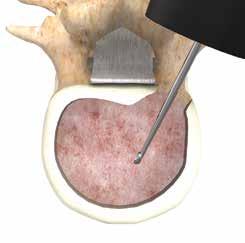 Intradiscal and extradiscal work can be executed, as one would normally perform during a microdiscectomy.
