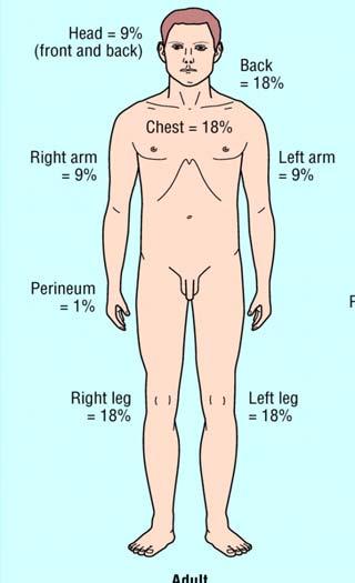 SECONDARY SURVEY Total Body Surface Area Assessment Wallace Rule of nines to assess BSA.