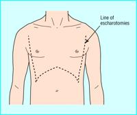 Escharotomies A circumferential deep dermal or full thickness burn is inelastic and on an extremity will not stretch.