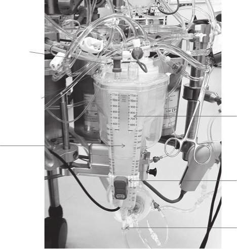 alarm Outlet to CPB pump Vacuum-assisted venous drainage may be used to optimize venous