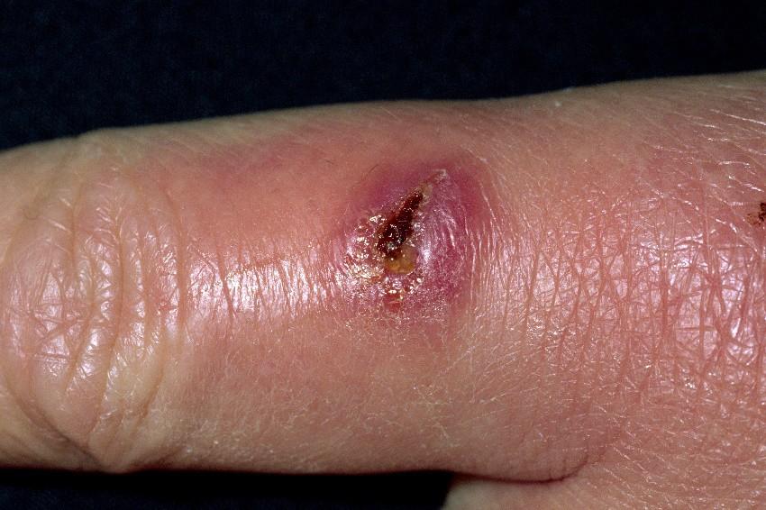 Signs and Symptoms Wound Infection Red, swollen and warm wound area Pain Pus Fever