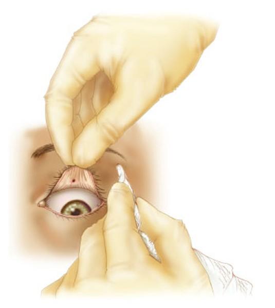 For Dirt or a Small Particle in the Eye continued If particle remains and is visible, try to brush it out.