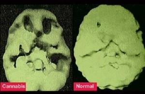 Marihuana Normalno Slika : Prikaz poškodbe možganov pri