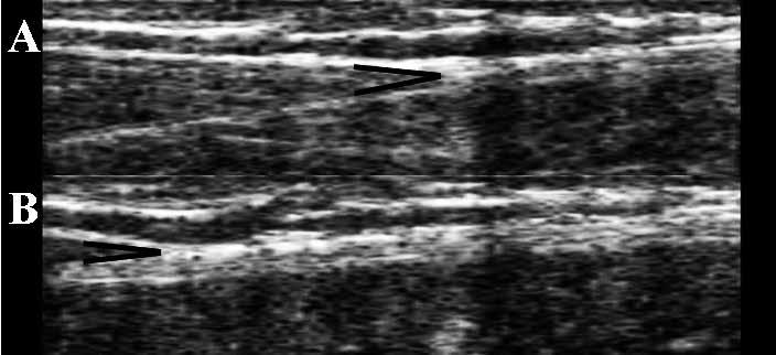 Achilles Tendon After Running Activity 455 (R 2 =.96 ± 0.04) determined the relationship between ankle angle and muscle-tendon-junction displacement (between 4.5 ± 2.0 mm and 11.0 ± 2.5 mm).