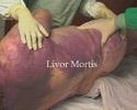 FRESH STAGE Livor Mortis Livor Mortis: Process when body