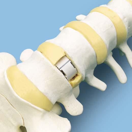 3 Insert implant Insert the implant according to Step 4 of