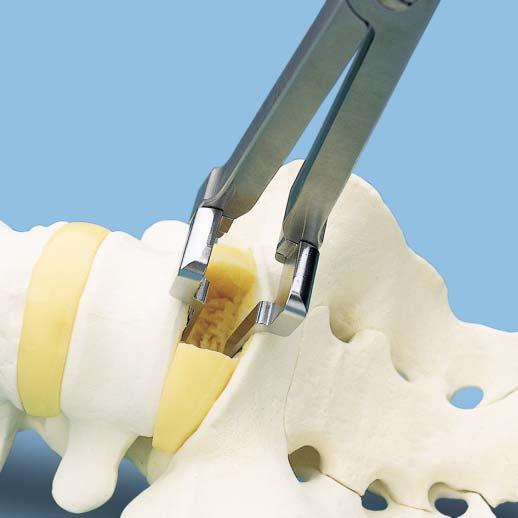Straight Anterior Approach 1 Expose the disc and prepare the endplate Expose the midline of the intervertebral disc so that the center of the implant will sit on the vertebral midline.