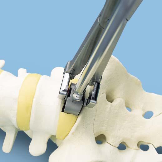3 Determine implant size Instruments 397.041 FRA Trial Spacers, anterior 397.924 396.957 Trial Spacer Handle or 397.