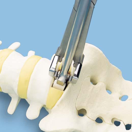 Instrument 397.023 Impactor, crescent Release the FRA Implant Holder by loosening the locking screw, and withdraw the instrument.