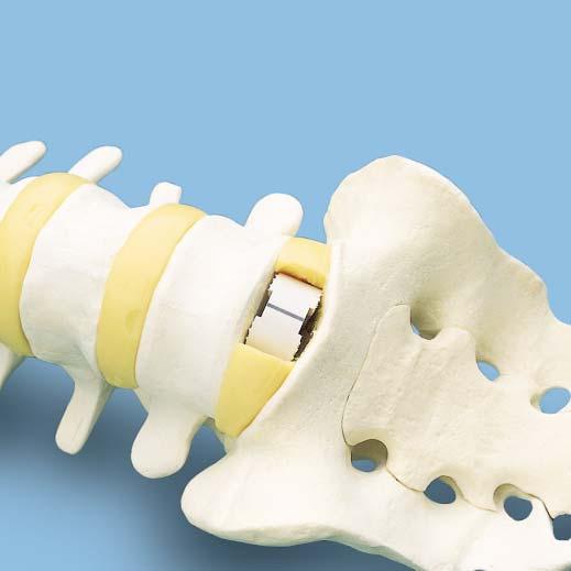 Important: Before use, ensure that the impactor fits flush against the implant.