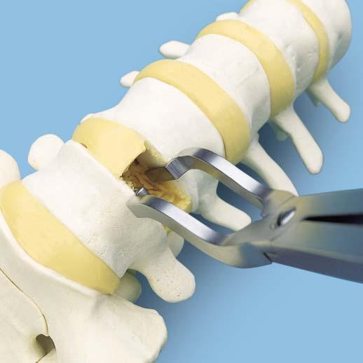 Anterolateral Approach (30 Offset) 1 Expose disc and prepare endplate For anterolateral insertion, the center of the implant will sit 30 offset to the anterior vertebral midline.