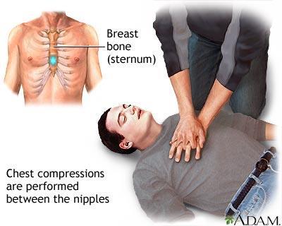 Hand Placement Put the heel of one hand on the center of the victim s chest on the lower half of the sternum Put the
