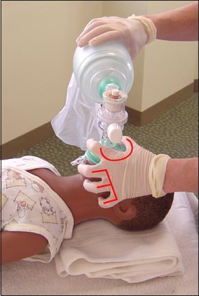 Using the EC technique, hold the mask in place while you hold the airway open.