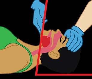 Opening the Airway When a victim is unresponsive, the tongue relaxes and can block the flow of air through the airway, especially if the victim is lying on their back.