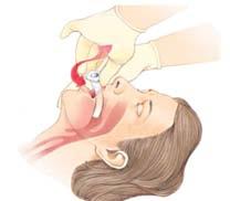 It is important to suction when fluids or foreign matter are present or suspected, because the airway must be open and clear in order for the victim to breathe.