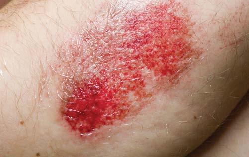 The following are the four main types of open wounds: Abrasion (Figure 10-9). o The skin has been rubbed or scraped away (e.g., scrape, road rash or rug burn).