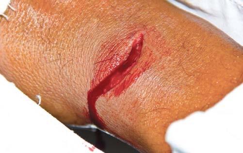 Cleaning the wound with soap and water is important to prevent infection. Figure 10-9 Abrasion Laceration (Figure 10-10).
