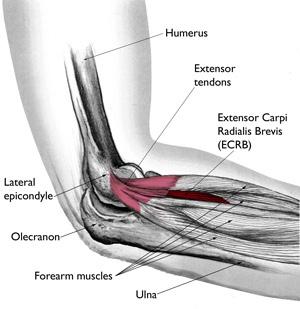 Tennis Elbow (Lateral Epicondylitis) Page ( 1 ) Tennis elbow, or lateral epicondylitis, is a painful condition of the elbow caused by overuse.