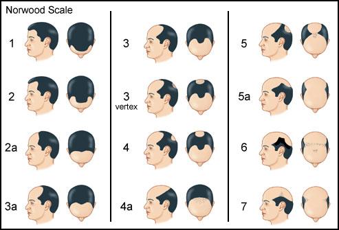 unusual pattern of hair loss accompanies the hair loss. A skin biopsy and blood tests also may be necessary to diagnose disorders responsible for the hair loss.