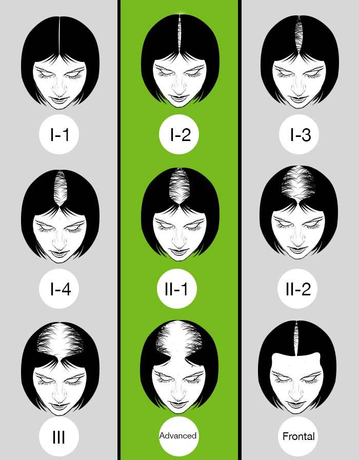 recession; similar to its male counterpart, female androgenic alopecia rarely leads to total hair loss. The Ludwig scale grades severity of androgenic alopecia in females.