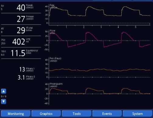 TRANSPULMONARY PRESSURE MONITORING Respiratory system pressures Peak, plateau <30, PEEP Driving pressure (DP) < 15 cmh20