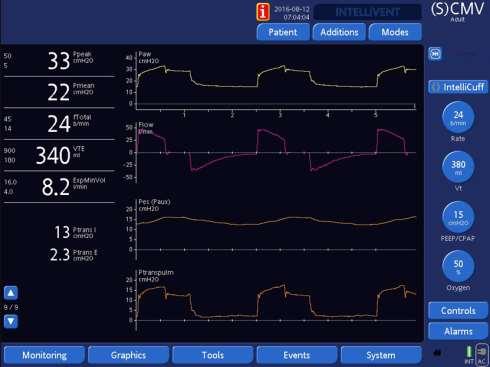 CASE 1 PRONE POSITION Less cardiac oscillations Significant improvement in respiratory mechanics DPtp