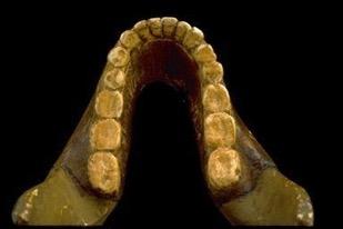 molars Formerly called robust