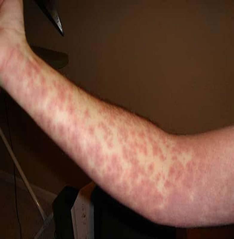 Heat Rash Cause: Inflamed skin Signs & Symptoms: Rash with pink pimples, itching,