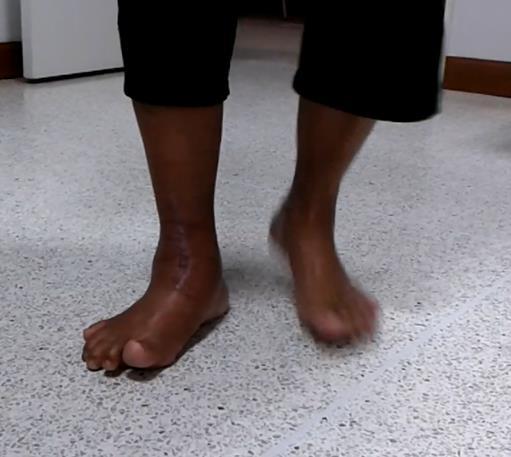 PURPOSE The purpose of this study was to report the relationships between validated patient-reported outcome, health-related quality of life, and gait characteristics using a wearable foot