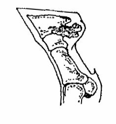 #4 #5 #6 A O G Sidebone The collateral cartilages of the coffin bone, which form the bulbs of the heel, gradually calcify and turn to bone.