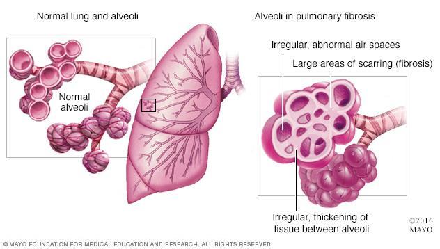 Pulmonary Disorders: Fibrosis PF and IPF
