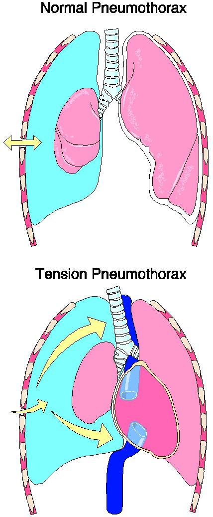 In addition to diseases that make breathing difficulty, it is possible to get air to enter the pleural space causing a pneumothorax.
