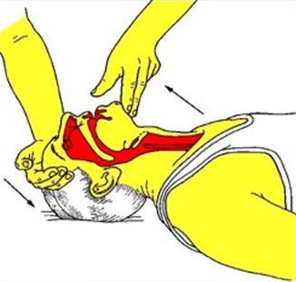 airway is open Other options to open the airway The jaw thrust technique is an alternative method to the Head tilt and chin lift for opening the airway, particularly in a victim with a
