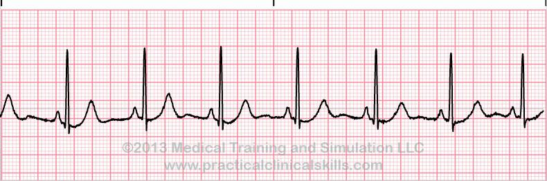 Implementation of RTS Smoothness is the heartbeat of the paving operation. An EKG indicates that something is abnormal with the heart, but does not diagnose the underlying cause(s).