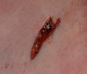 b. Small caliber and low-velocity bullets tend to stay lodged in the body. Here is a slit like exit wound.