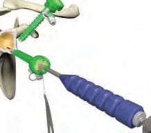 Using a grasper, retrieve the other suture limb from the non-operative cannula and move it so that it exits the operative cannula. Clamp both limbs of the suture tail ends to prevent slippage.