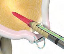 Remove the suture threader tab from the shaft of the insertion device, and pull to feed the sutures through the anchor eyelet.